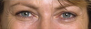 crows feet before Botulinum Toxin treatment Crows feet before Botulinum Toxin treatment