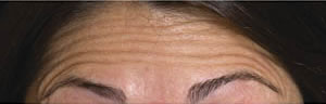 Forehead lines before Botulinum Toxin treatment Forehead lines before Botulinum Toxin treatment