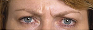 Frown lines before Botulinum Toxin treatment Frown lines before Botulinum Toxin treatment