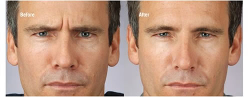 Botulinum Toxin for Men Before and After Treatment Botulinum Toxin for Men Before and After Treatment