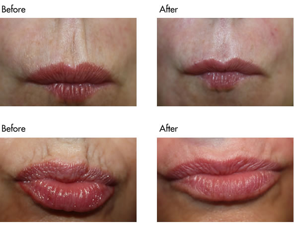 Facial Fillers Before and After - Lip Lines